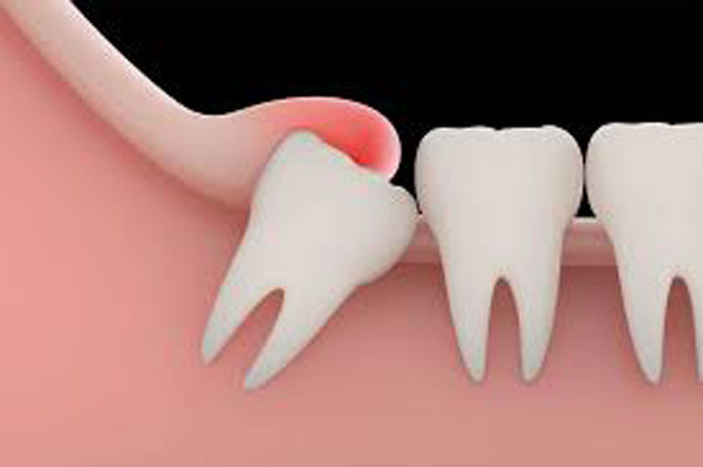 Impaction / Impacted Tooth Extraction